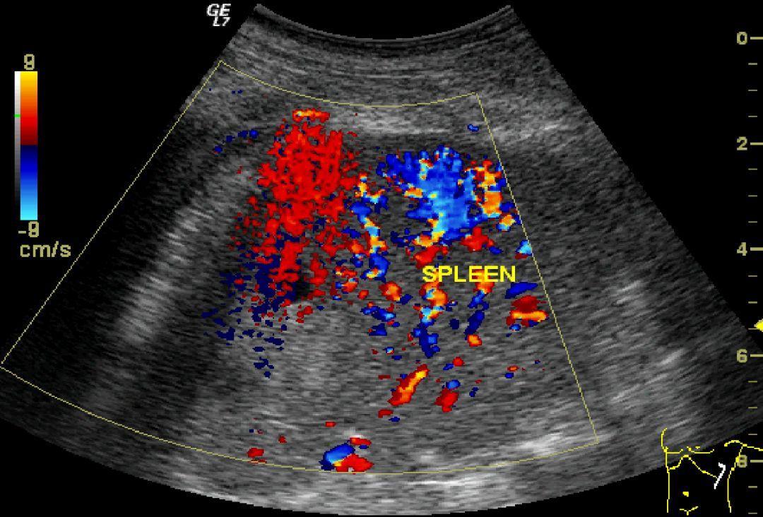 腹膜后血肿的并发症,外伤性腹膜后出血或血肿并发症