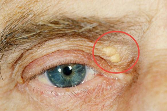 眼睛上有胆固醇块怎么消除,眼睛胆固醇结晶怎么治疗
