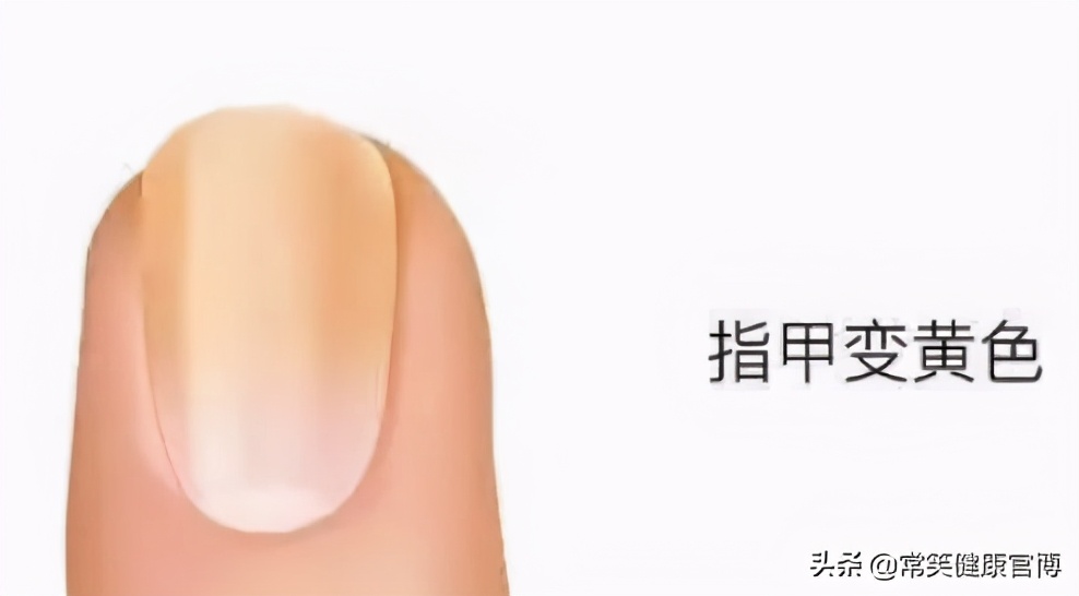 指甲出现各种问题的图片,指甲出现这些症状可能是灰指甲