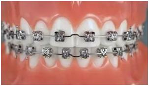 矫正牙齿你要知道的事,牙齿矫正路漫漫