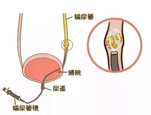 钬激光肾结石无创手术,钬激光碎石后结石还没出来怎么办