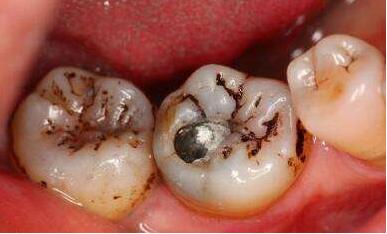 牙齿发黑发黄怎么快速去除,牙齿突然发黄发黑牙龈出血