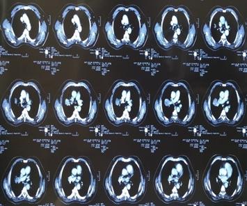 局部放疗能彻底治好吗,放射治疗全过程两大阶段