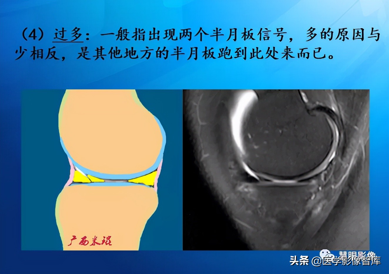 膝关节半月板损伤的解剖结构图,半月板mri解剖图解