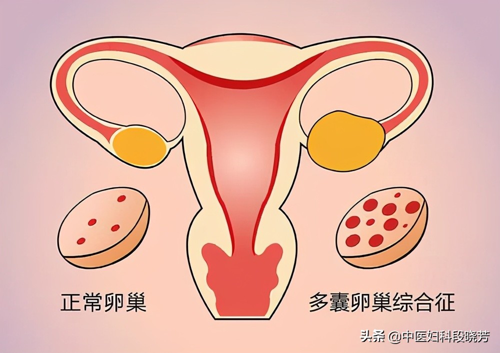 18岁的小姑娘得了多囊怎么治疗,专家教你正确预防多囊的并发症