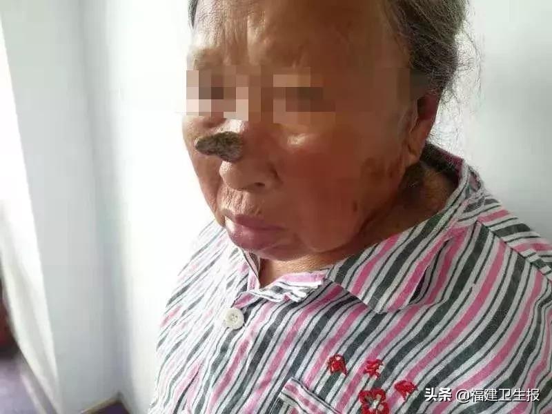 宁德八旬老大娘鼻上长“犀牛角”，一查竟是癌！医生提醒这些疙瘩别轻视！