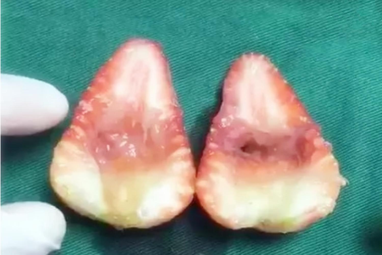 国外女子19年间剖腹产11次，打破世界最高纪录，连医生都觉得神奇