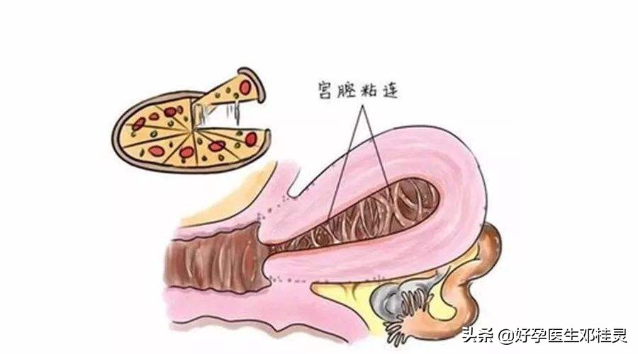 人流后痛经量少一定是宫腔粘连吗,人流后宫腔粘连吃中药会来月经吗