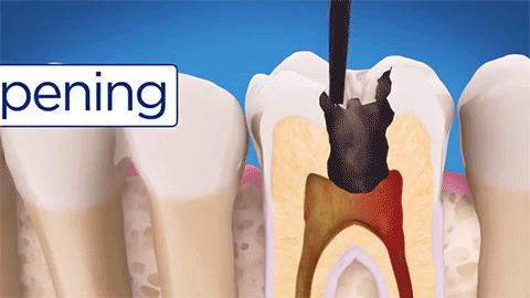 牙蛀了要补吗,牙齿蛀了一点需要补牙吗