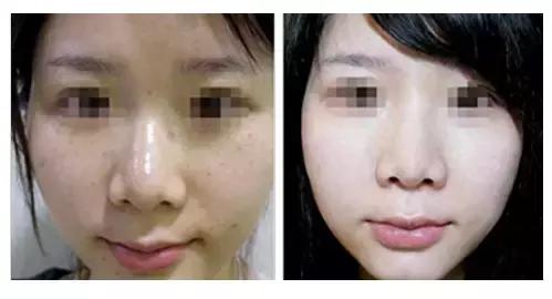 光子嫩肤alma,光子嫩肤alp