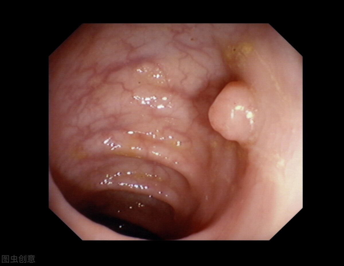 结节息肉的最佳治疗方法,中医对结节和息肉怎么治