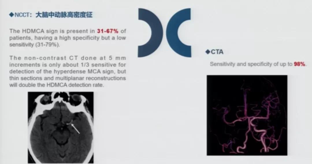 急性脑中风影像诊断选择,急性脑卒中首选哪种检查方法