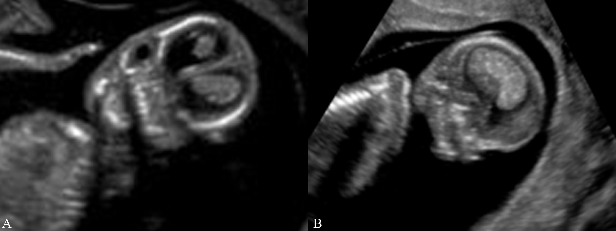 做四维彩超时胎儿动态视频,四维彩超胎儿一切都发育正常