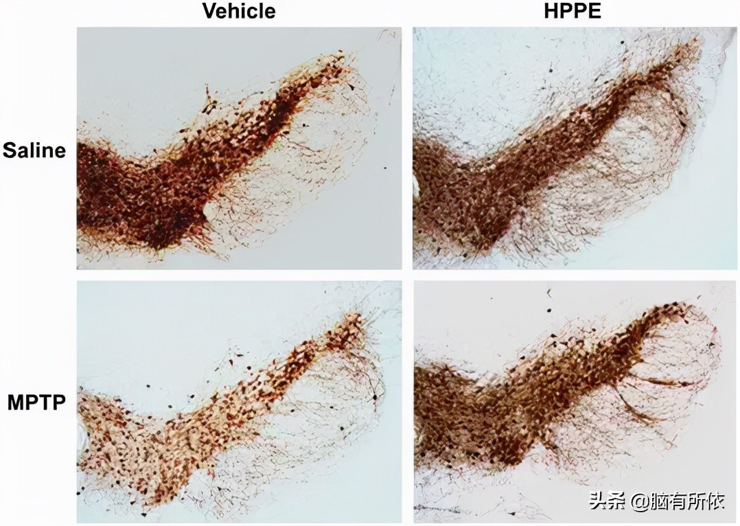 帕金森基因新药,明年有望上市的帕金森新药