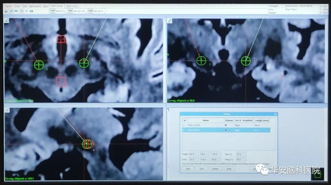 梅杰氏综合征dbs手术成功率,梅杰综合征微创手术打几个孔