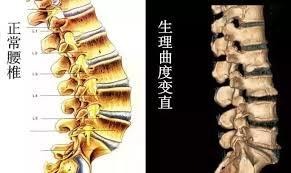腰椎直的还能变弯么,腰椎生理弯曲变直和腰突哪个严重