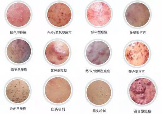 痘克清苦瓜祛痘膏测评,痘肌油皮护肤品大推荐