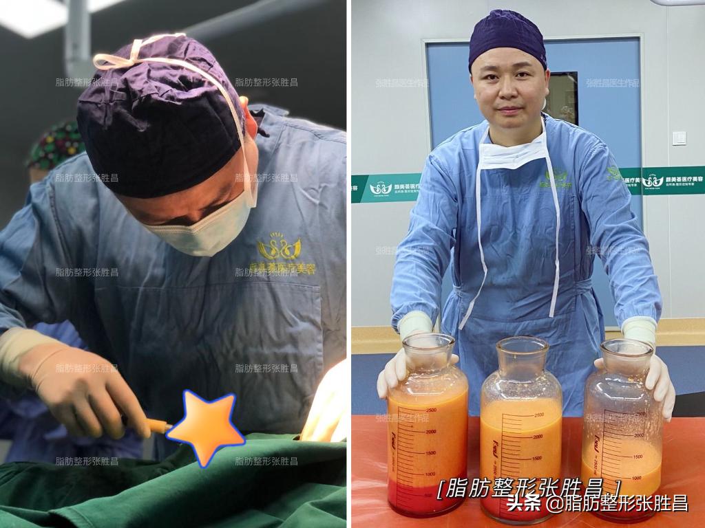 做腰吸脂就立马瘦下来了吗,瘦的人还可以做腰腹吸脂吗