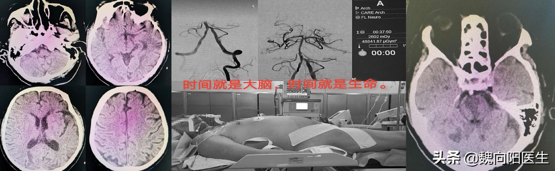 良性位置性眩晕鉴别,怎样判断眩晕是颈椎还是耳石症