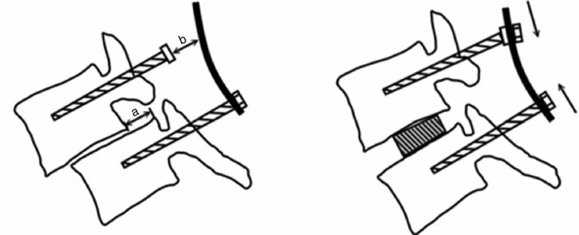 腰椎退行性变诊断书怎么写,腰椎退行性滑脱最好的治疗方法