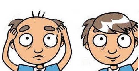 植发后怎么护理水肿严重,植发后怎么护理最好