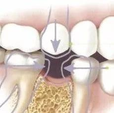 牙齿残根算牙齿缺失吗,口腔有缺失牙不处理好吗