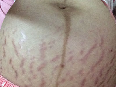 妊娠纹出现的前兆和过程,妊娠纹的前兆是什么