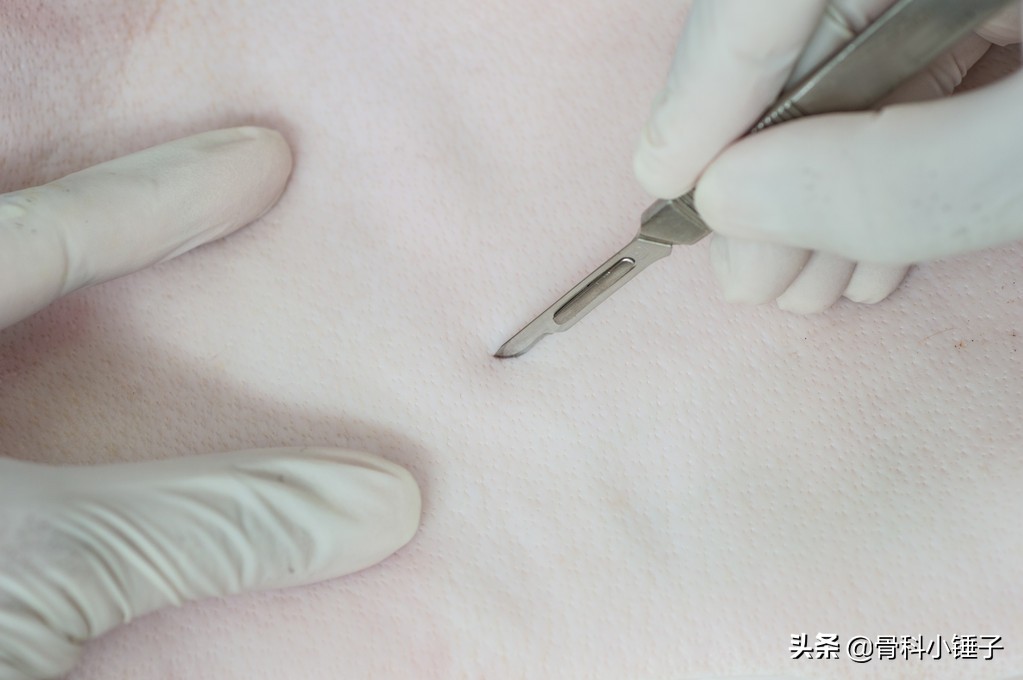 关节置换手术切口是用什么缝合的,常见骨科手术切口的缝合技术总结