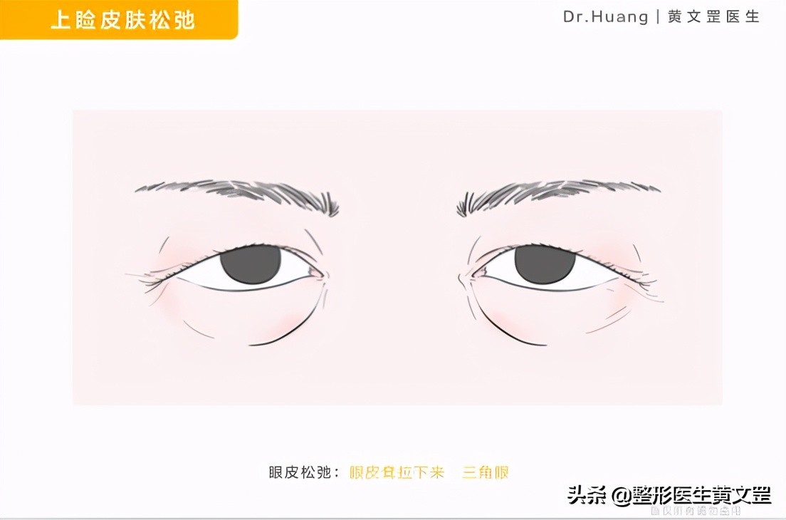 你的眼睛为什么看起来那么凶？三角眼该怎么办？