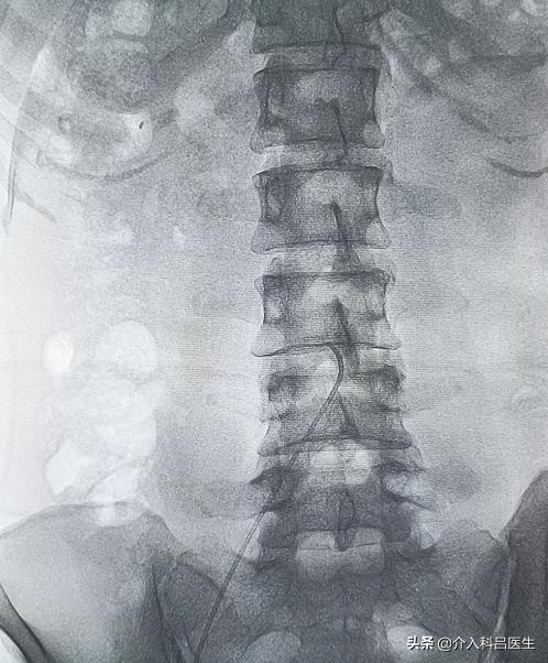 女性卵巢和子宫发育阶段,切除子宫和卵巢最好的方法