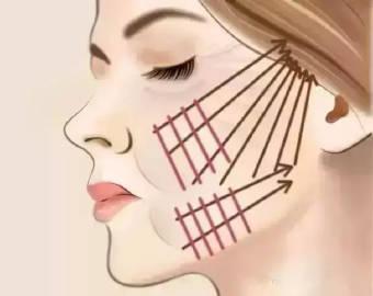 抗衰建议做拉皮还是线雕,面部抗衰线雕一般用什么