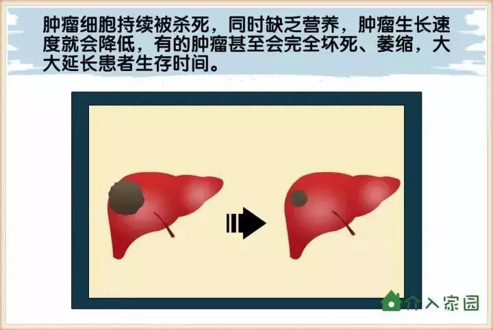 肝癌最常用的治疗方案，为什么是它？