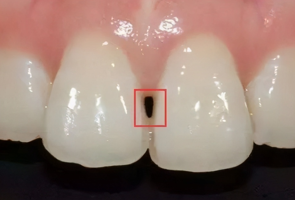 牙齿为什么会黑三角,牙齿出现黑三角是为什么