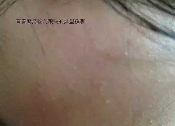 粉刺是什么应该怎么治,粉刺怎么样才算好了