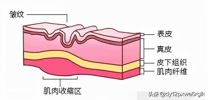 内窥镜小切口面部除皱术,内窥镜除皱术
