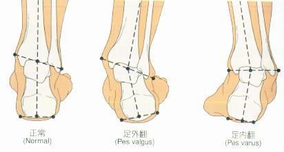 偏瘫足内翻足外翻,足内翻足外翻崴脚