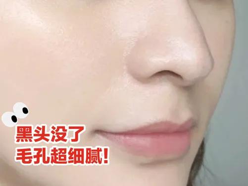 深度清理毛孔黑头教程,清洁毛孔里的黑头和白头小妙招
