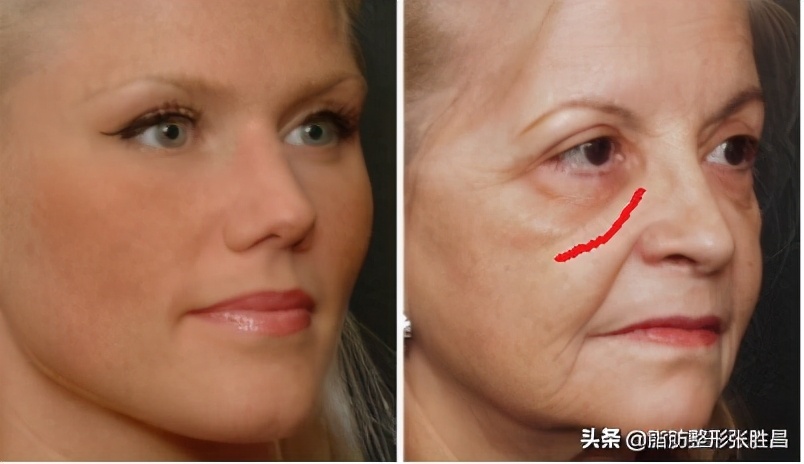 ps改善脸部皱纹方法有哪些,印第安皱纹怎么去除
