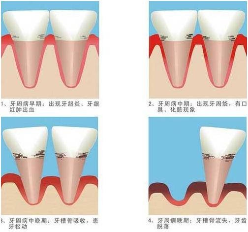 牙周炎引起的口腔溃疡久治不愈,上火引起的牙周炎怎么治疗