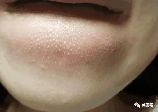 嘴巴下巴长了许多小白点怎么处理,嘴巴下巴长了许多小颗粒怎么去除