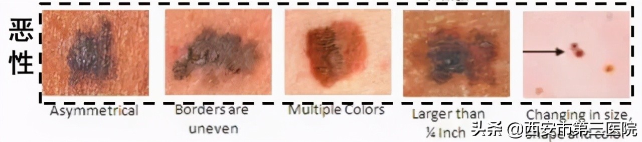 色素痣到底该不该去除,色素痣到底该不该去掉