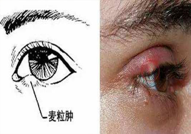 眼睛长了针眼怎么包扎,眼睛长针眼了怎么办才能消肿图片