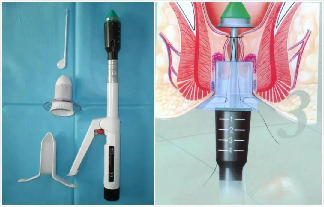 还在哺乳期的宝妈痔疮该如何处理,产后痔疮3个月了还没好怎么办