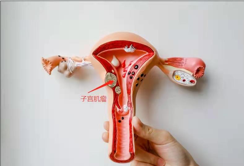 子宫肌瘤最好的治疗方法是哪种,目前治疗子宫肌瘤最好的方法