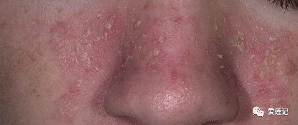 脂溢性皮炎为什么会出很多痘,脂溢性皮炎和痘痘的区别