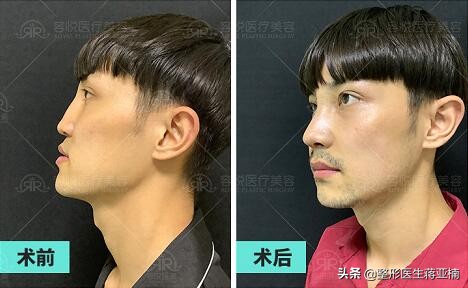 隆鼻也分性别,男女隆鼻差异知多少?