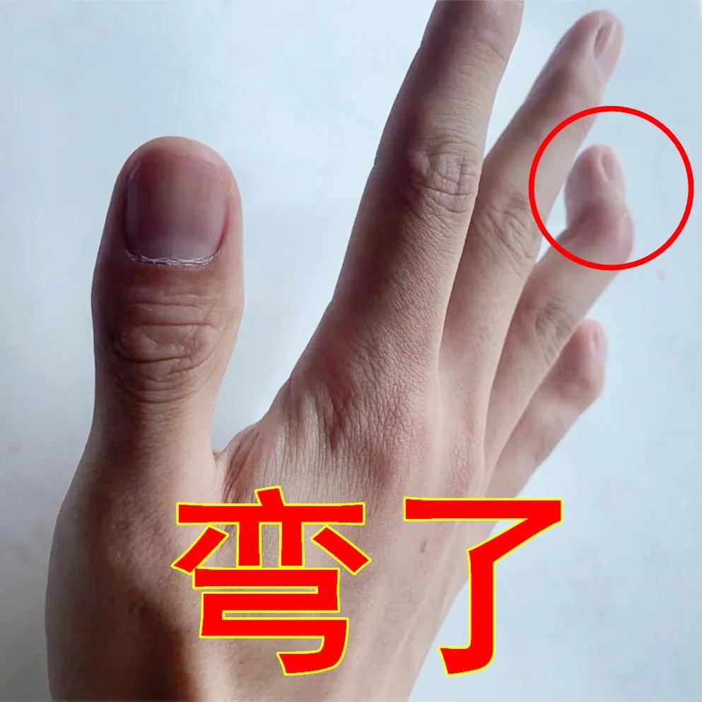 什么能促进手部肌腱断裂自愈,肌腱断裂保守治疗可以自愈吗