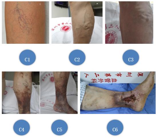 “医生，我腿上一条条青筋是怎么回事，像蜘蛛网、像蚯蚓”