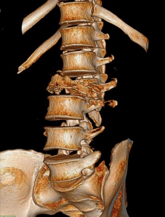 从瘫痪到重新站起来,瘫痪后重新站起来的有吗