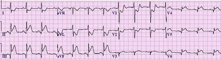 常见心梗特殊心电图,各部位心梗心电图详解
